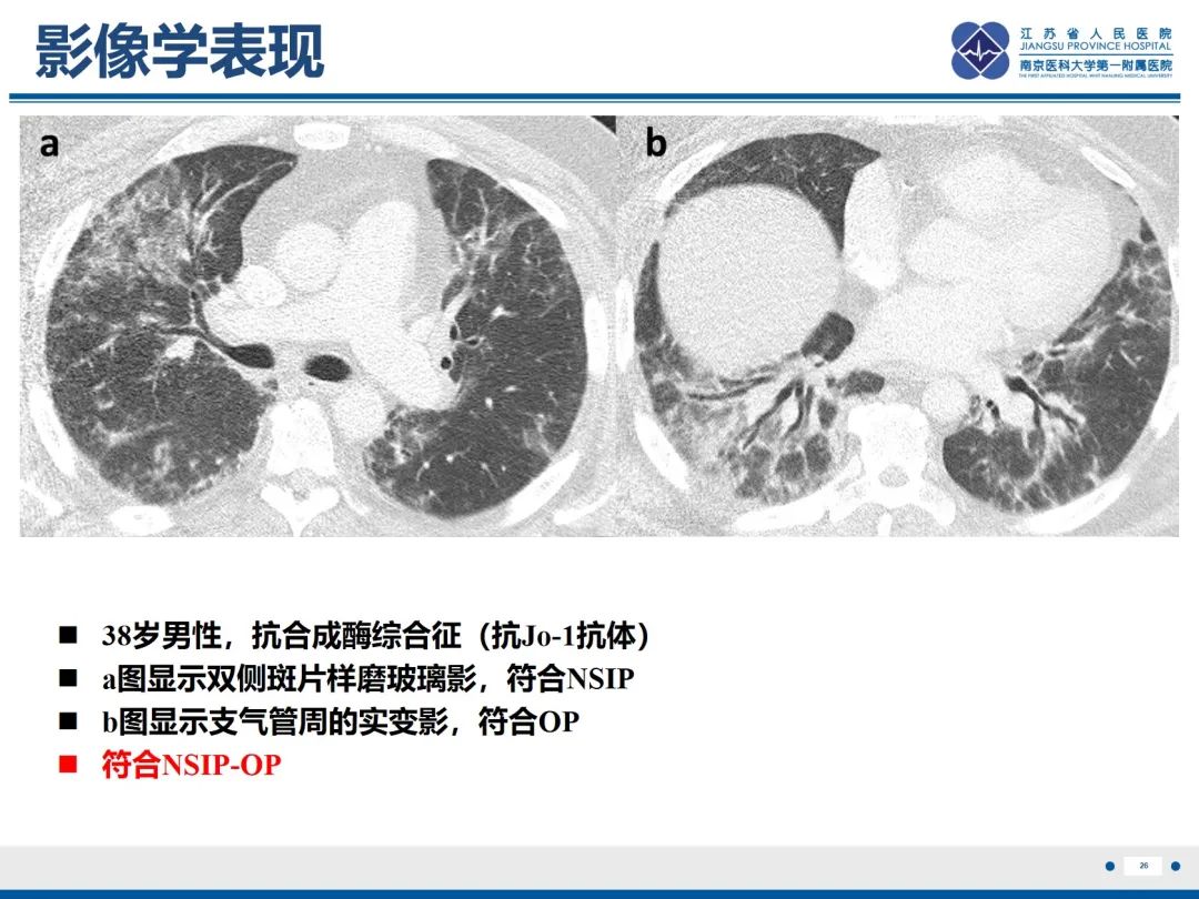 影像PPT - 【PPT】抗合成酶综合征相关间质性肺病-27