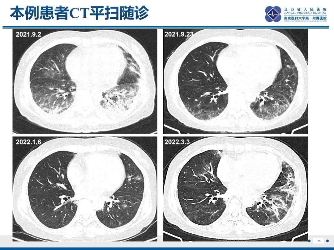 影像PPT - 【PPT】抗合成酶综合征相关间质性肺病-31