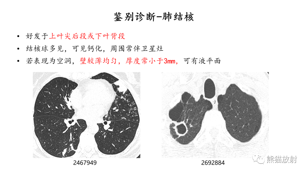 影像PPT - 【病例】ANCA相关性血管炎2例肺部CT影像-41