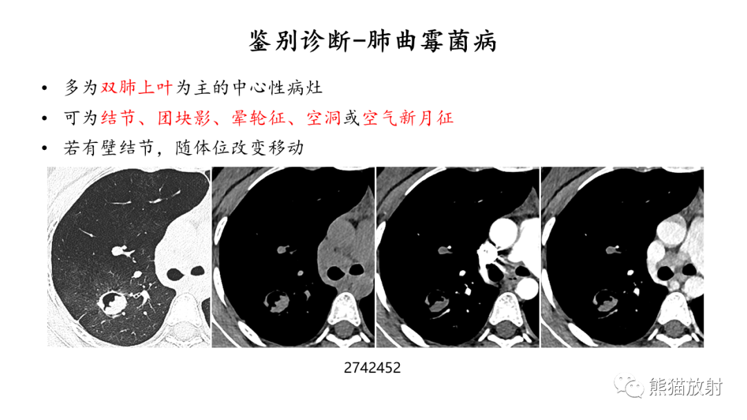 影像PPT - 【病例】ANCA相关性血管炎2例肺部CT影像-43