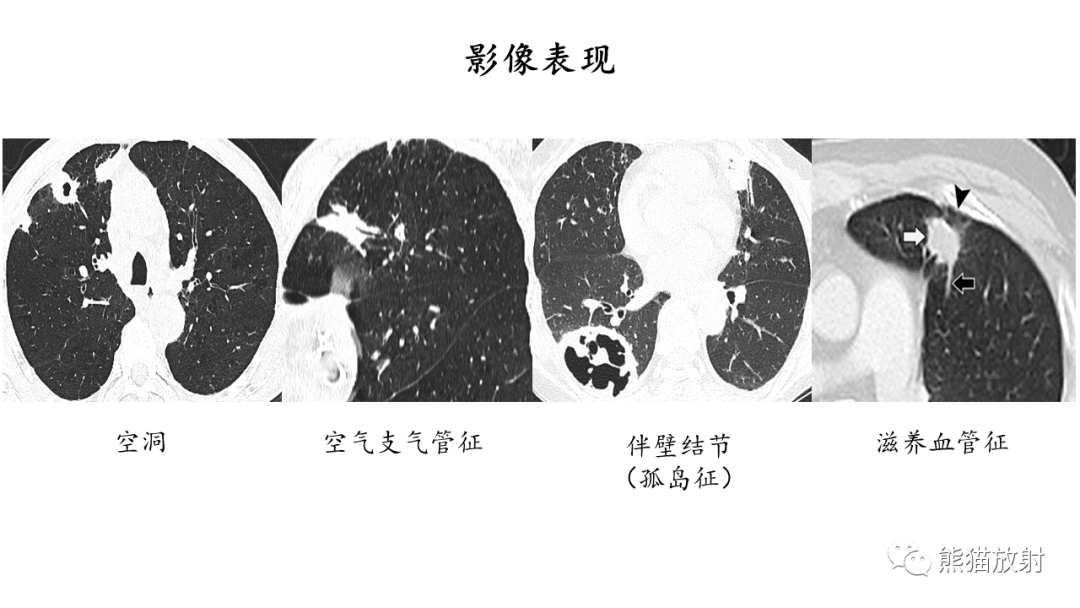影像PPT - 【病例】ANCA相关性血管炎2例肺部CT影像-40