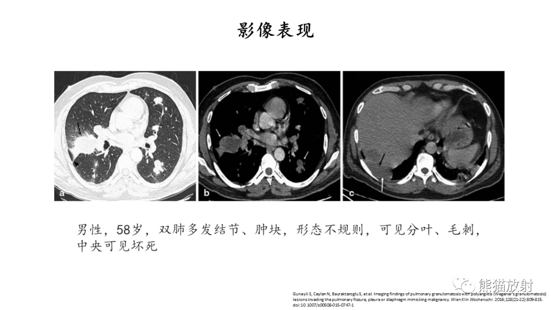 影像PPT - 【病例】ANCA相关性血管炎2例肺部CT影像-38