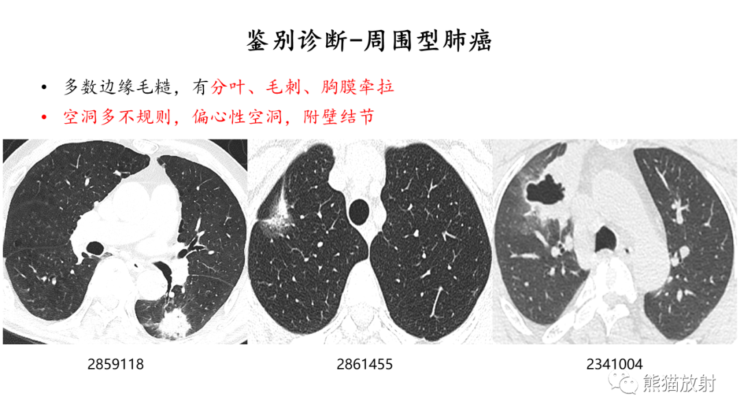 影像PPT - 【病例】ANCA相关性血管炎2例肺部CT影像-42