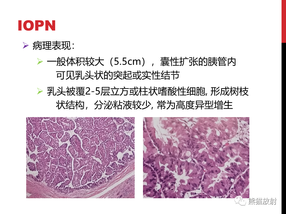 影像PPT - 【PPT】胰腺导管内肿瘤的影像诊断-21
