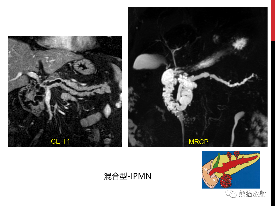 影像PPT - 【PPT】胰腺导管内肿瘤的影像诊断-18