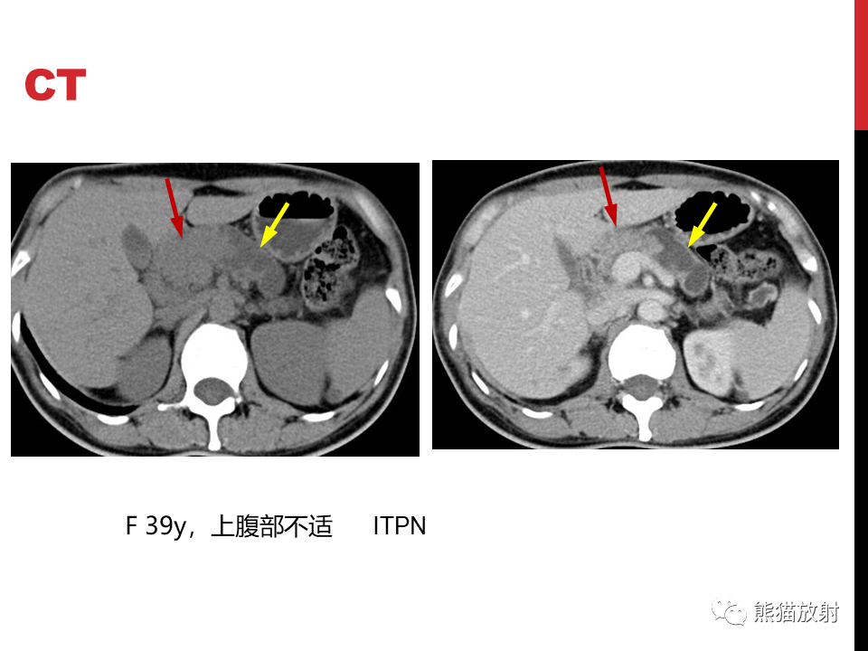 影像PPT - 【PPT】胰腺导管内肿瘤的影像诊断-32