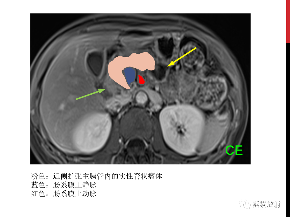 影像PPT - 【PPT】胰腺导管内肿瘤的影像诊断-35