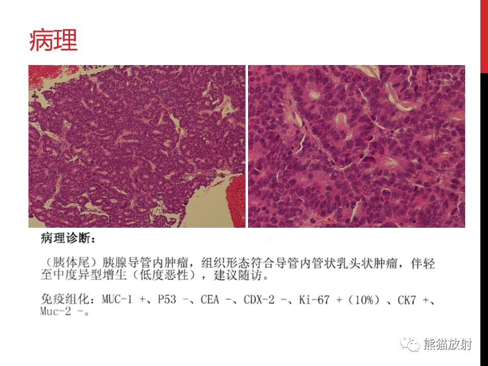 影像PPT - 【PPT】胰腺导管内肿瘤的影像诊断-37