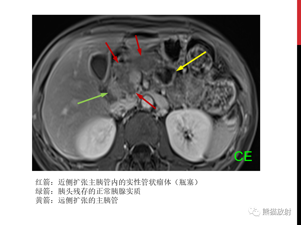 影像PPT - 【PPT】胰腺导管内肿瘤的影像诊断-34