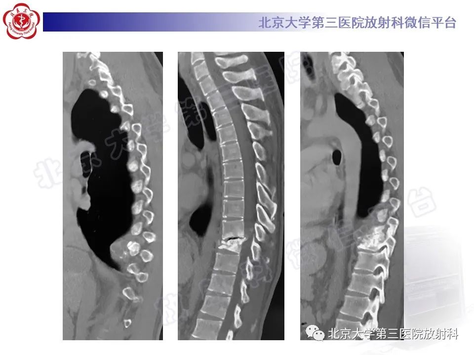 影像PPT - 【PPT】骨包虫病-5