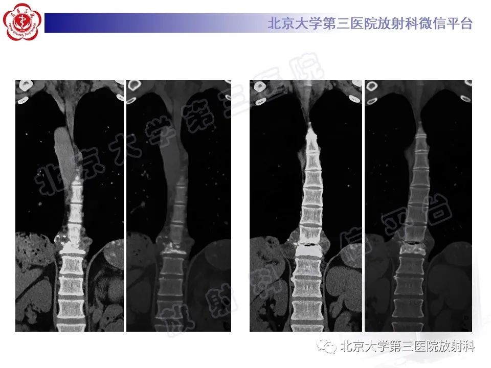 影像PPT - 【PPT】骨包虫病-4