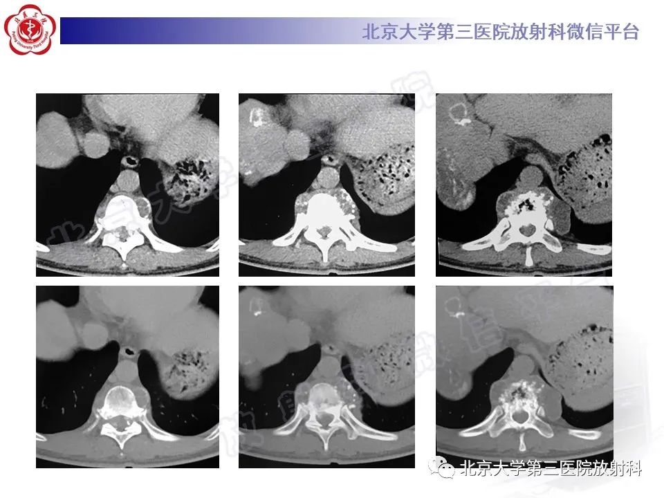 影像PPT - 【PPT】骨包虫病-3