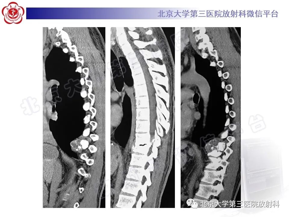 影像PPT - 【PPT】骨包虫病-6