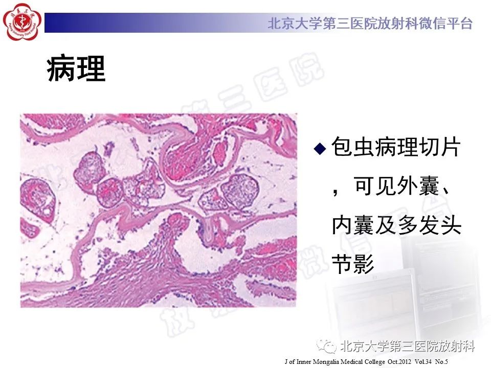 影像PPT - 【PPT】骨包虫病-15