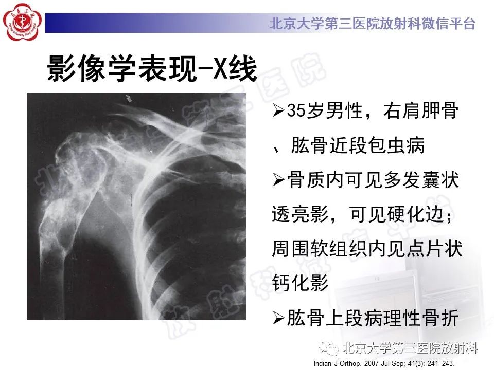 影像PPT - 【PPT】骨包虫病-19