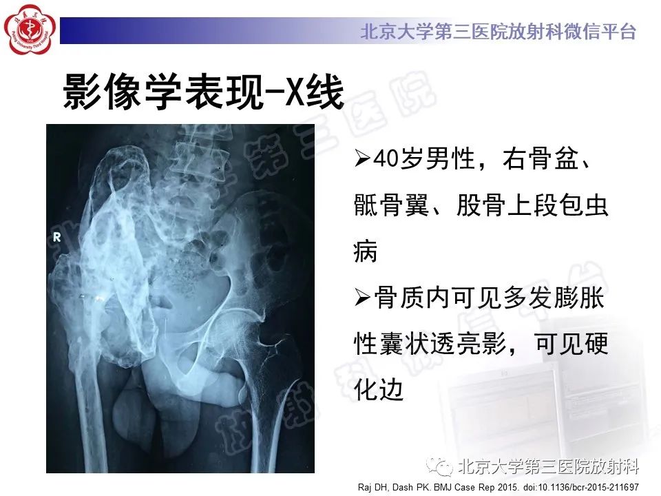 影像PPT - 【PPT】骨包虫病-20