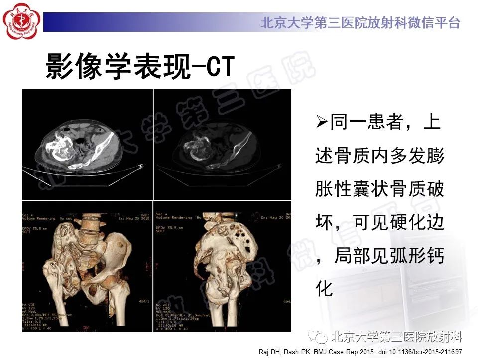 影像PPT - 【PPT】骨包虫病-23
