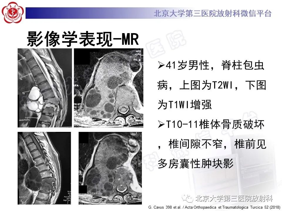 影像PPT - 【PPT】骨包虫病-26