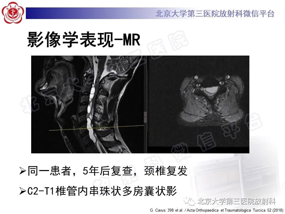 影像PPT - 【PPT】骨包虫病-27