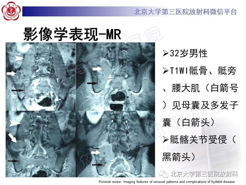 影像PPT - 【PPT】骨包虫病-28
