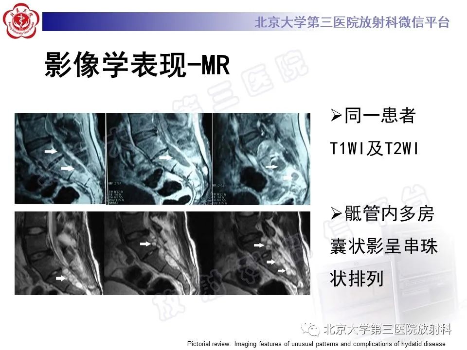 影像PPT - 【PPT】骨包虫病-29