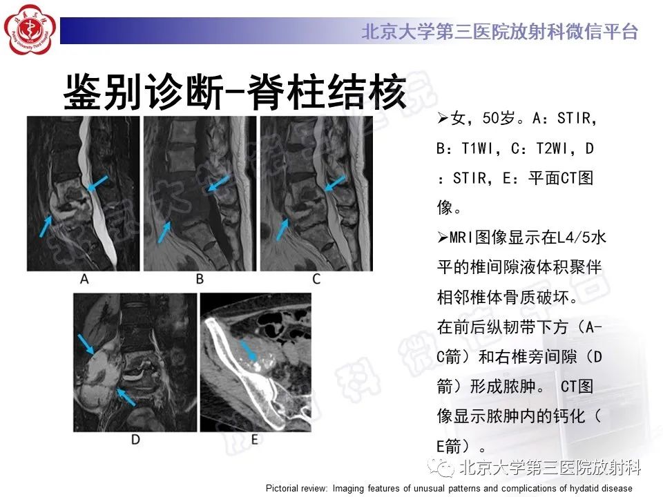 影像PPT - 【PPT】骨包虫病-31