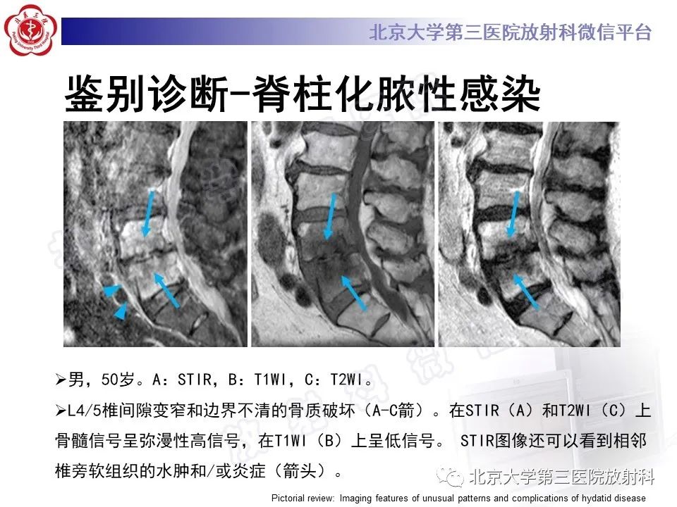 影像PPT - 【PPT】骨包虫病-33