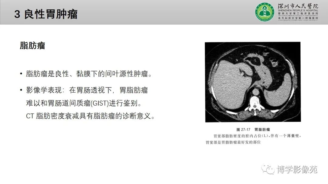 影像PPT - 【PPT】核心放射学读书报告—胃和大肠-11