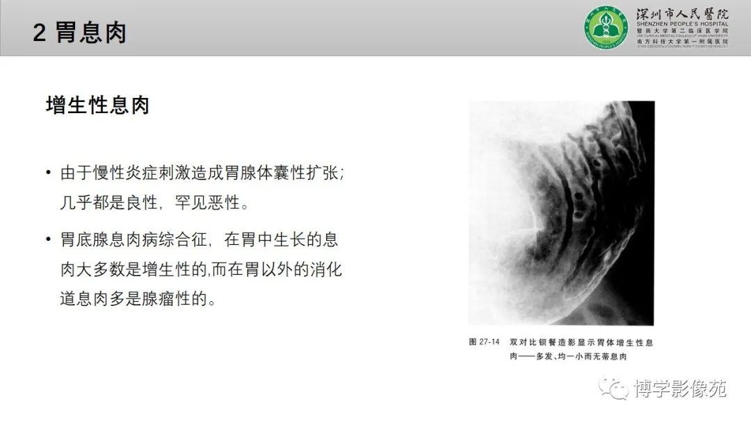 影像PPT - 【PPT】核心放射学读书报告—胃和大肠-8