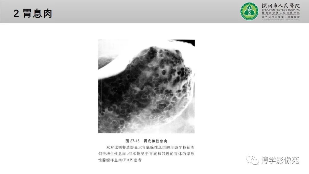 影像PPT - 【PPT】核心放射学读书报告—胃和大肠-9