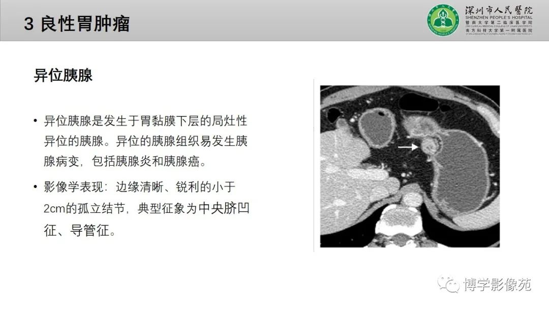影像PPT - 【PPT】核心放射学读书报告—胃和大肠-15