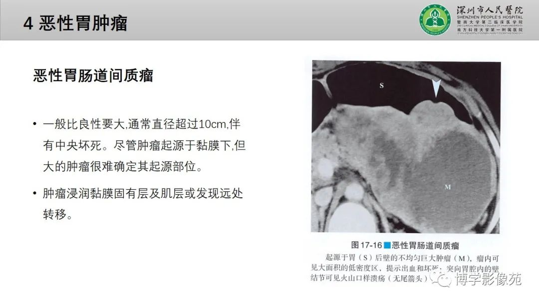 影像PPT - 【PPT】核心放射学读书报告—胃和大肠-19