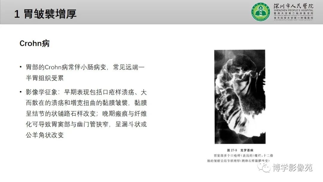 影像PPT - 【PPT】核心放射学读书报告—胃和大肠-7