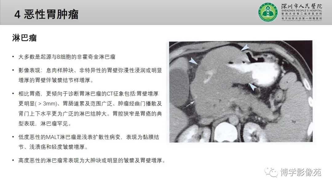 影像PPT - 【PPT】核心放射学读书报告—胃和大肠-22