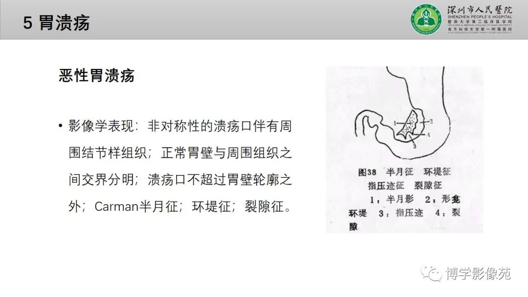 影像PPT - 【PPT】核心放射学读书报告—胃和大肠-24