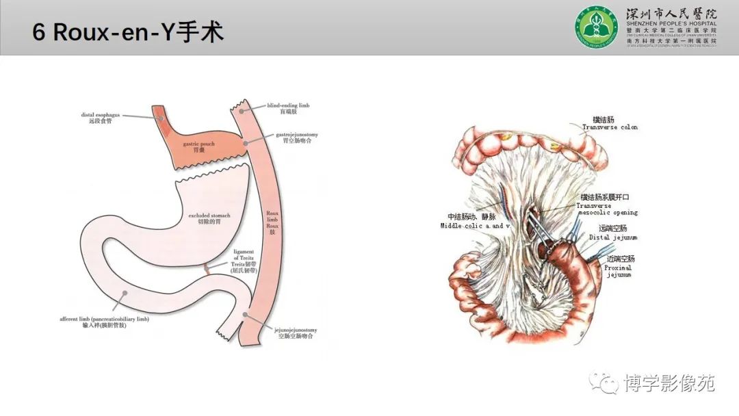 影像PPT - 【PPT】核心放射学读书报告—胃和大肠-28