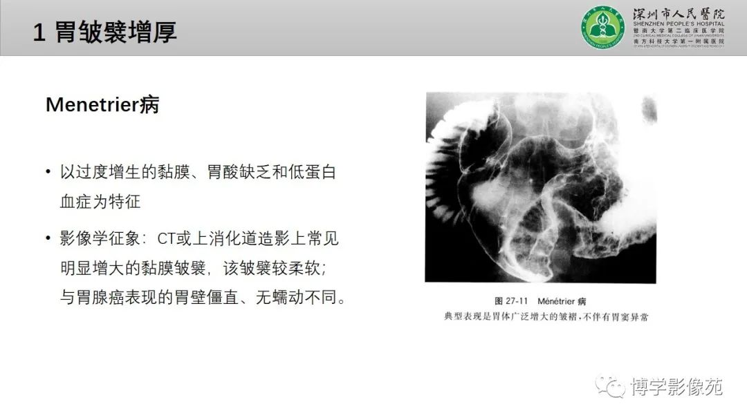 影像PPT - 【PPT】核心放射学读书报告—胃和大肠-6