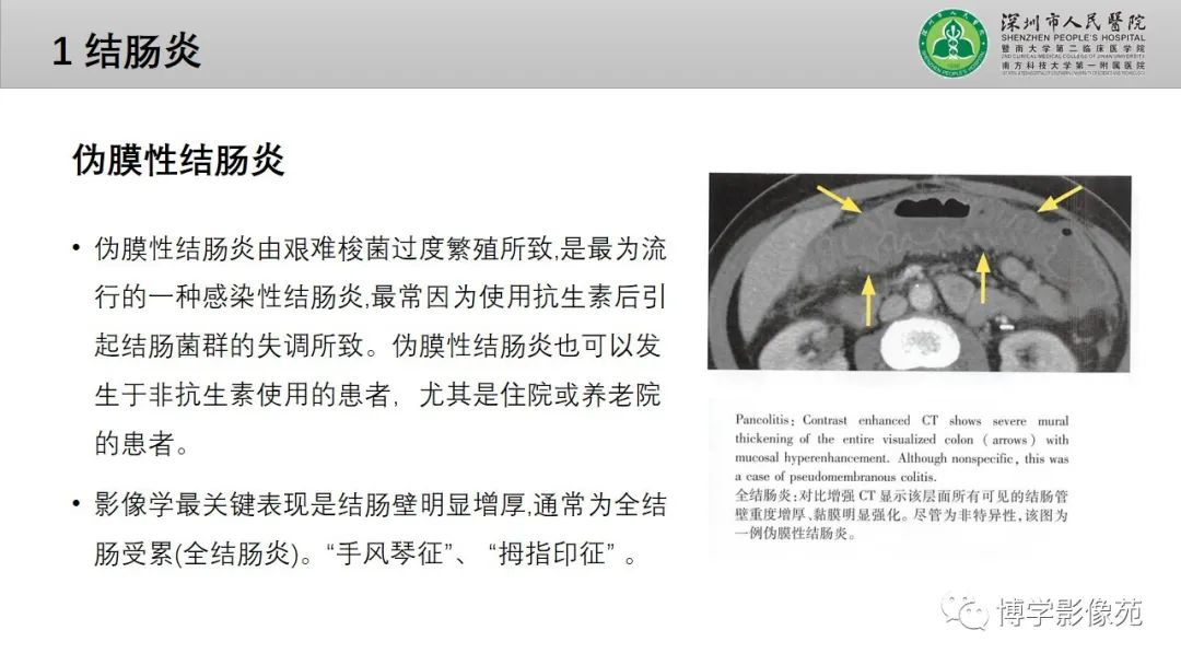 影像PPT - 【PPT】核心放射学读书报告—胃和大肠-35