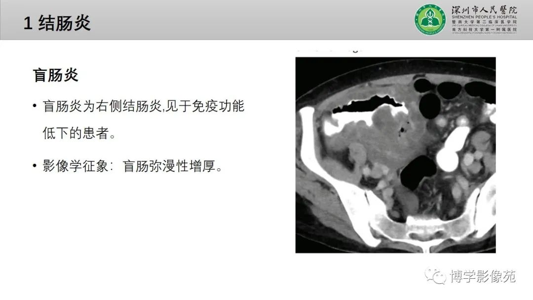 影像PPT - 【PPT】核心放射学读书报告—胃和大肠-39