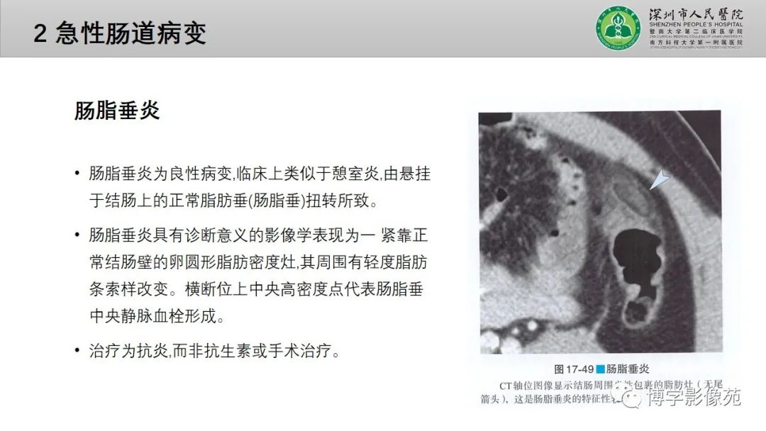 影像PPT - 【PPT】核心放射学读书报告—胃和大肠-44