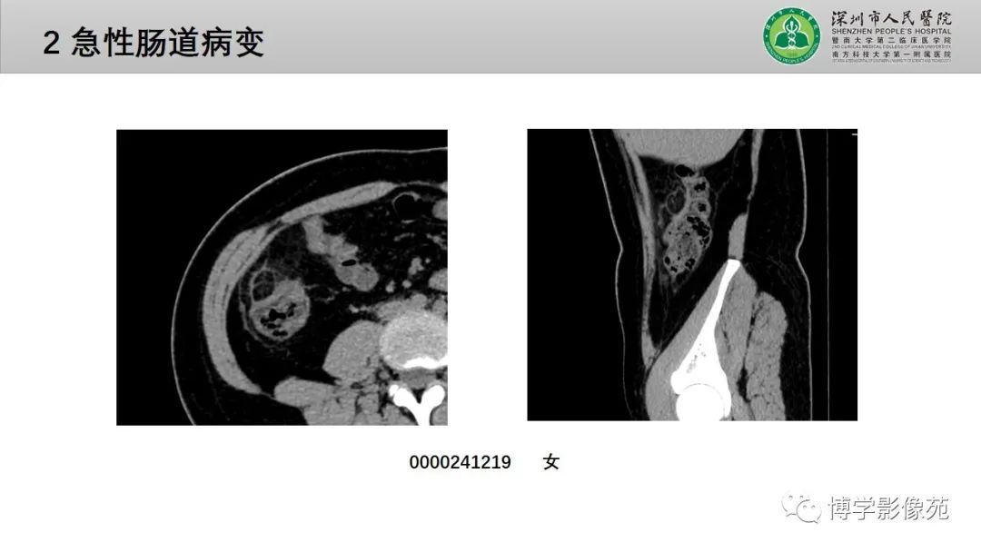 影像PPT - 【PPT】核心放射学读书报告—胃和大肠-45