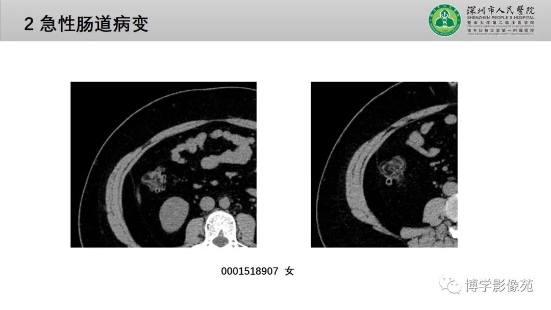 影像PPT - 【PPT】核心放射学读书报告—胃和大肠-43