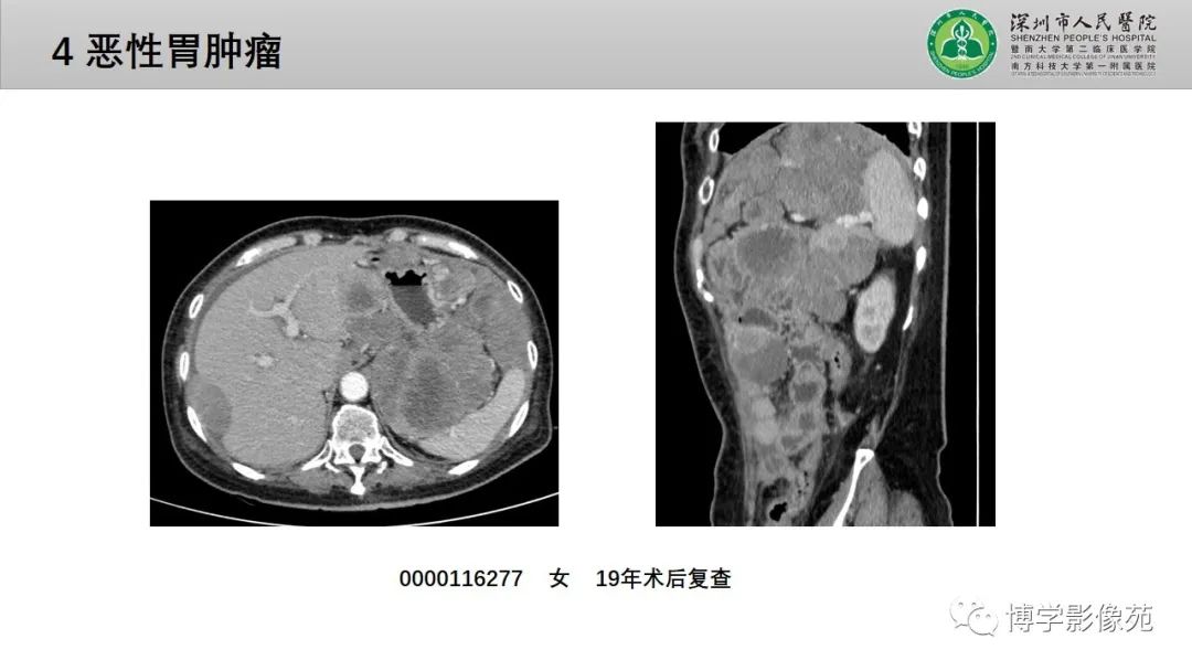影像PPT - 【PPT】核心放射学读书报告—胃和大肠-21