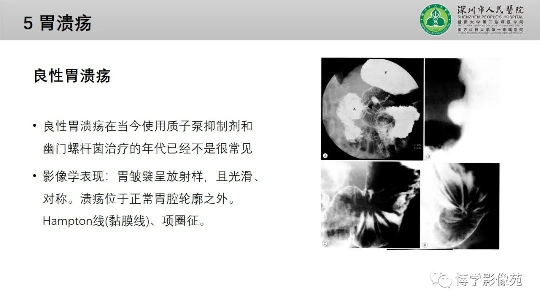 影像PPT - 【PPT】核心放射学读书报告—胃和大肠-23