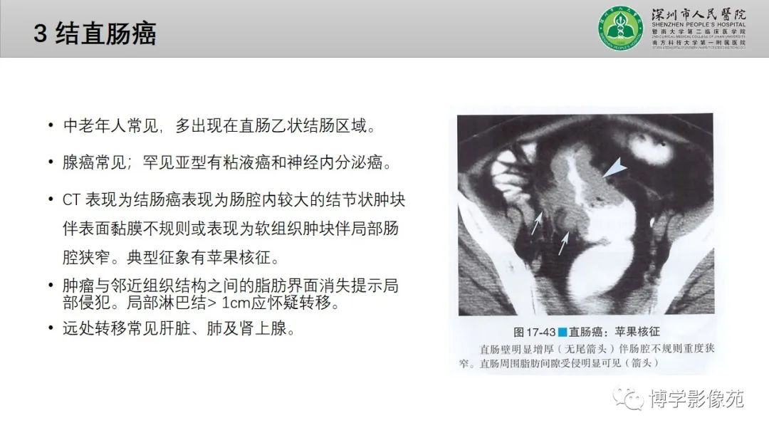 影像PPT - 【PPT】核心放射学读书报告—胃和大肠-46