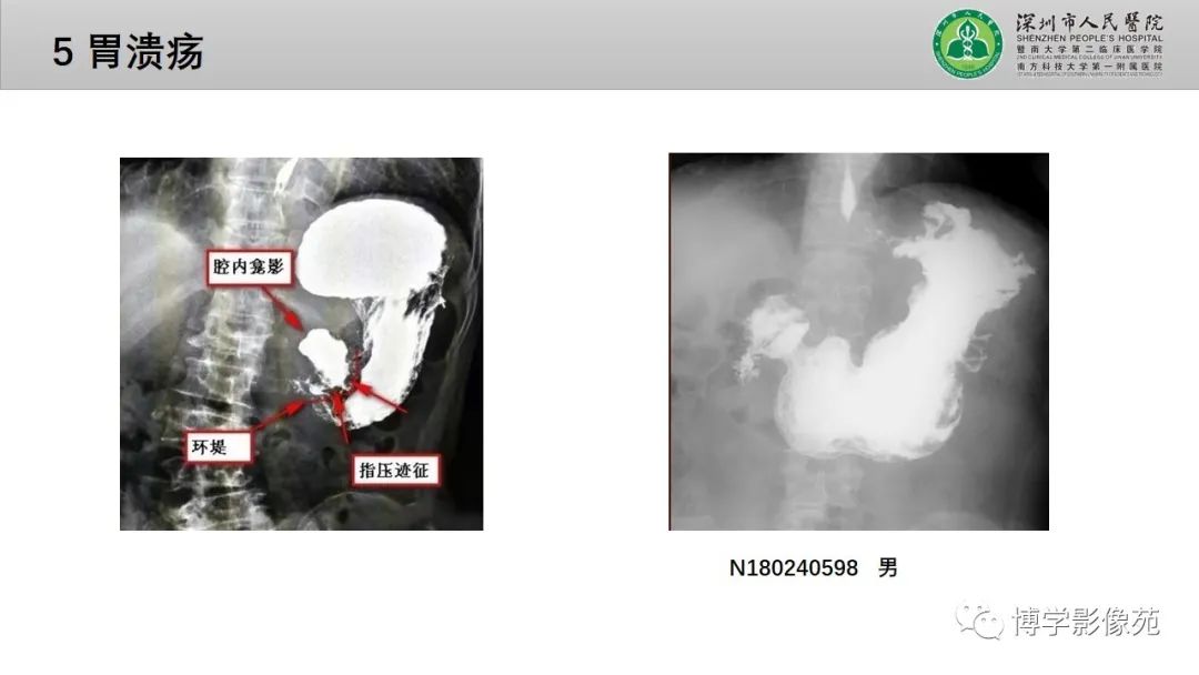 影像PPT - 【PPT】核心放射学读书报告—胃和大肠-25