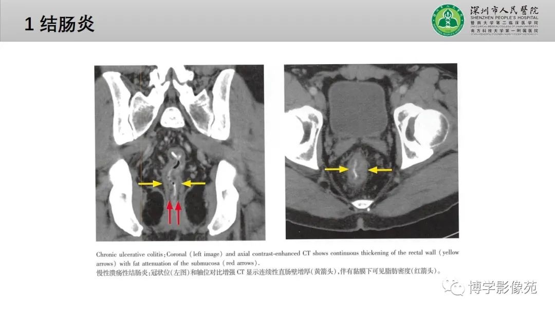 影像PPT - 【PPT】核心放射学读书报告—胃和大肠-37