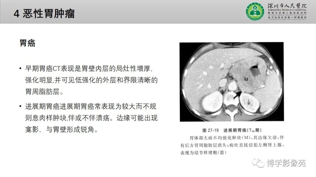 影像PPT - 【PPT】核心放射学读书报告—胃和大肠-17