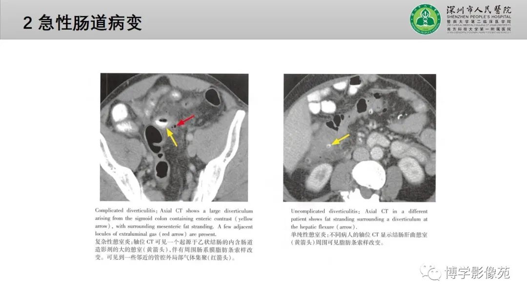 影像PPT - 【PPT】核心放射学读书报告—胃和大肠-42