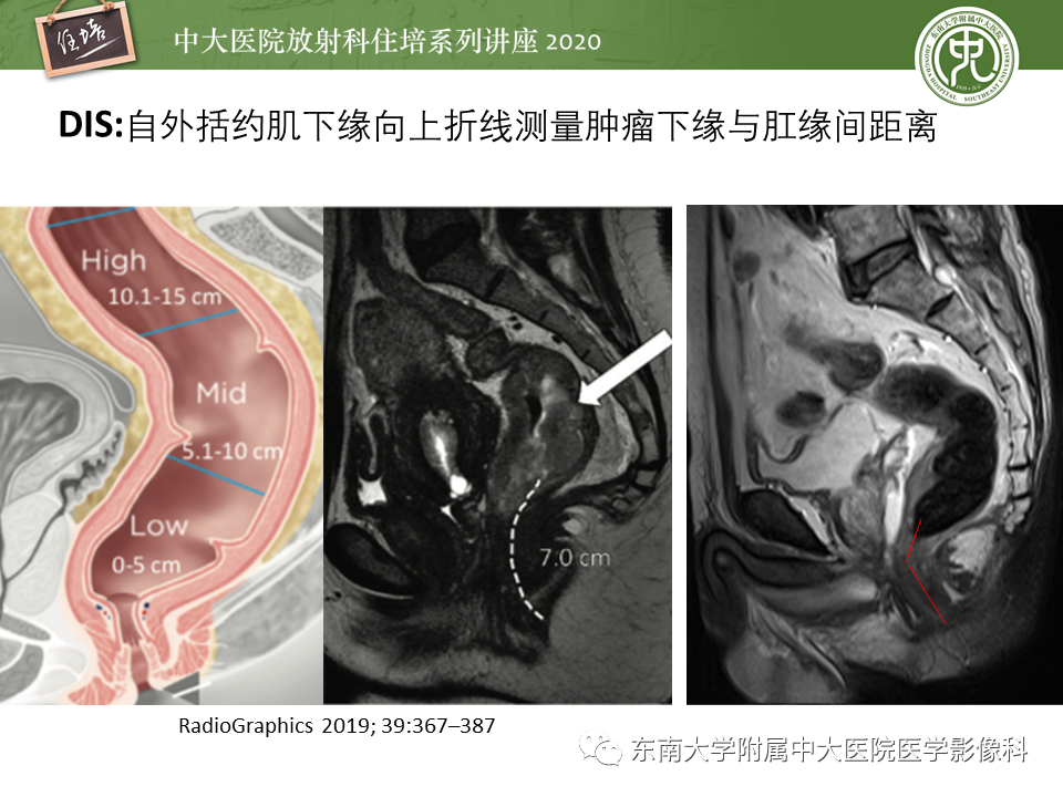 影像PPT - 【PPT】直肠癌影像临床分期注意事项-6